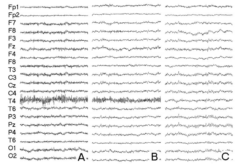 Рис. 3.6. Пример ЭЭГ фокального лица с выявленной «аномалией» по каналу регистрации Т4 после возникновения полтергейстного эпизода. 