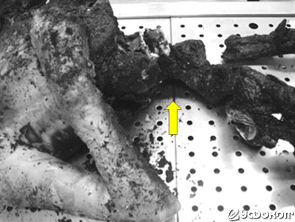 Рис. 4. Средняя треть тела (указана стрелкой) почти полностью превратилась в пепел. Анатомические структуры, включая позвонки, не распознаются.
