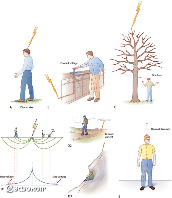 Разные варианты поражения молнией. Женщина была убита восходящим разрядом, вышедшим через лоб (Е). 