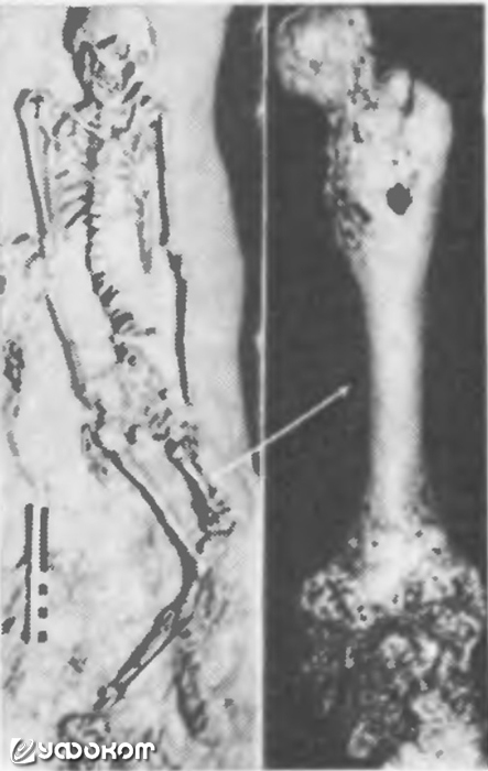 Скелеты, захороненные 2000 лет до нашей эры. Видна разница в длине бедренных костей. Иллюстрация из книги Е. П. Межениной «Врожденные уродства» (1974).