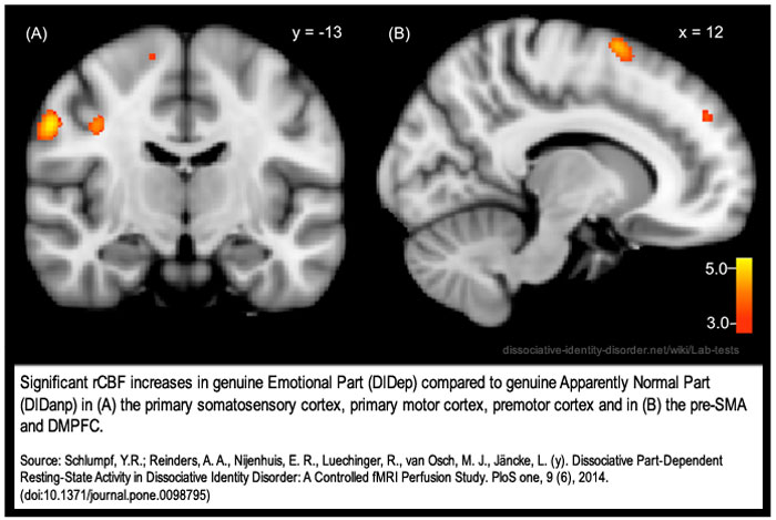 Измерение активности мозга при ДРИ. Источник: Wikimedia.org.