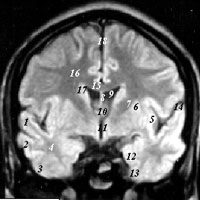 Человеческий мозг. Gyrus temporalis medius (средняя височная извилина) на рисунке обозначена цифрой 2.